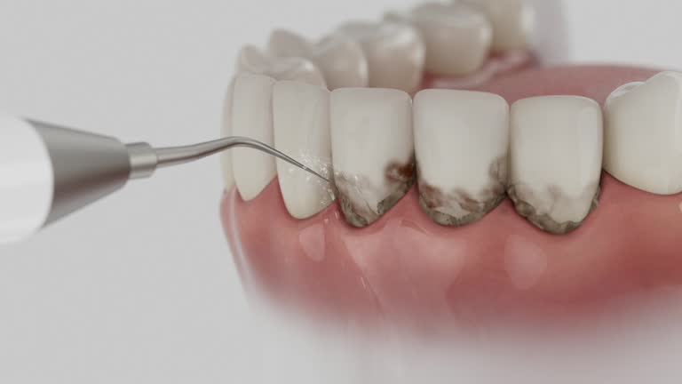 Reliable Wisdom Tooth Removal contractor in Elko, NV by Smile Center Dentistry